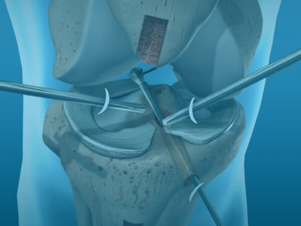 Patellar ACL Reconstruction