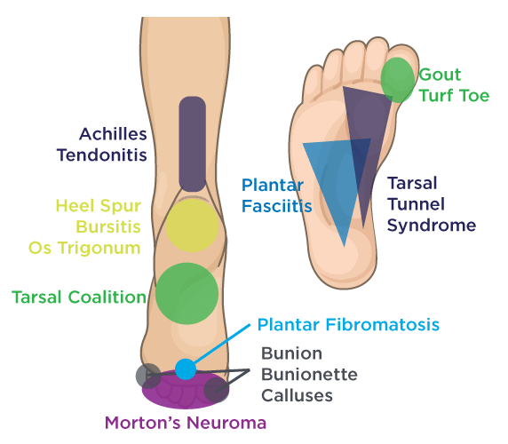 Pain in heel on sale and ankle area