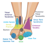 Pinpoint Your Foot and Ankle Pain | OrthoNebraska in Omaha NE