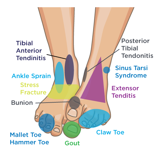 Pinpoint Your Foot and Ankle Pain | OrthoNebraska in Omaha NE