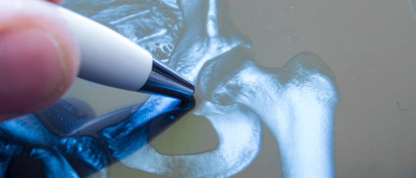X-ray of Hip with Pen Pointing at Joint