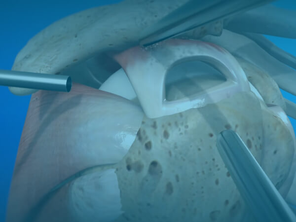 Rotator Cuff Repair Surgery by Experienced Shoulder Surgeons