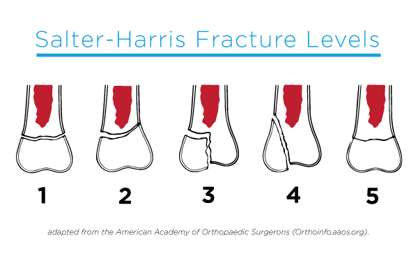 Salter Harris Growth Plate Fracture Levels (medical diagram)