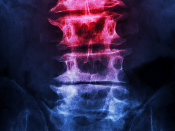 Spine with Pain