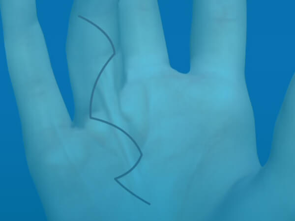  Limited Palmar Fasciectomy for Dupuytren’s Contracture