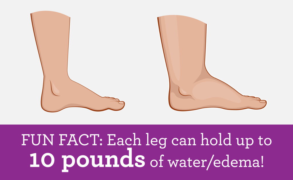 Fun Fact: Each leg can hold up to 10 pounds of water/edema!