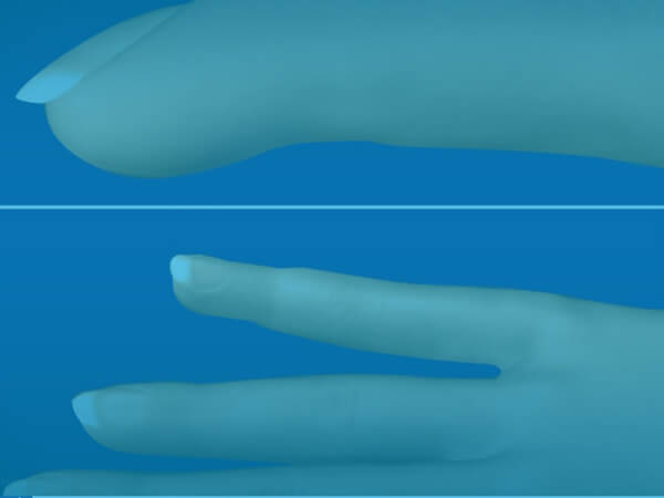 Finger Fracture Repair