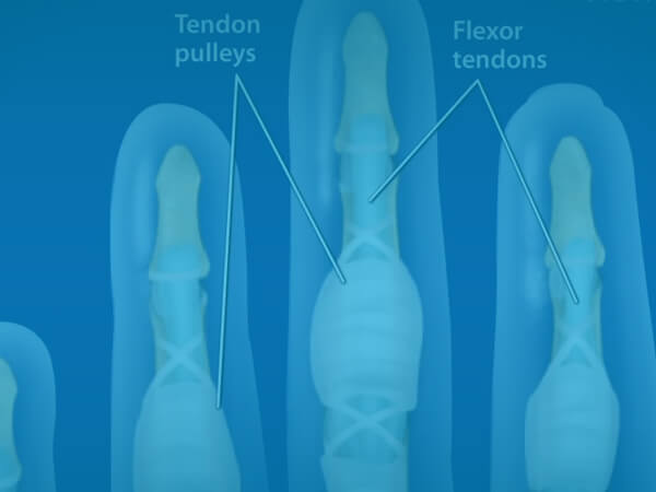 Flexor Tendon Injuries