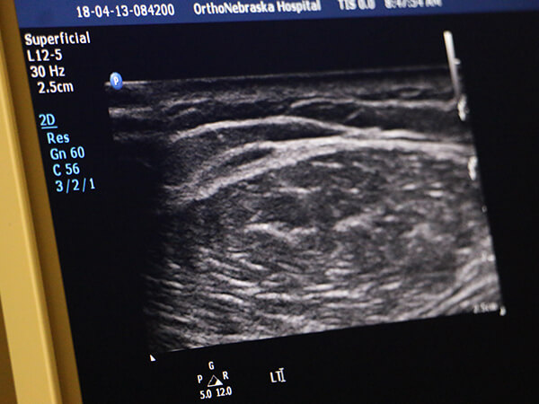 iovera ultrasound