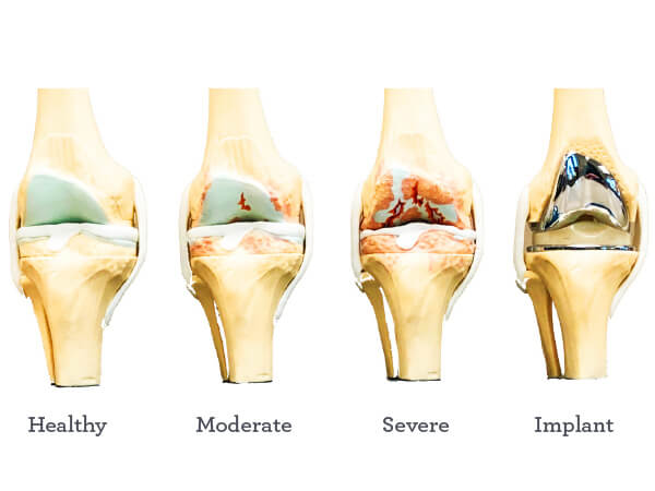 Progression of Knee Arthritis: Healthy, Moderate, Severe, Implant