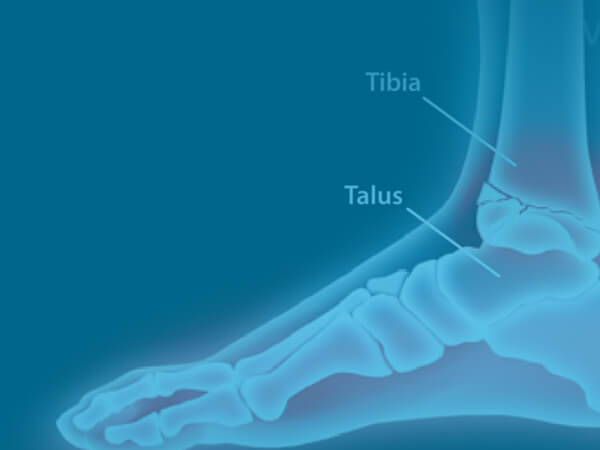 Pilon Ankle Fracture